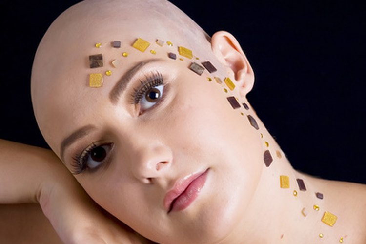 La alopecia areata es una enfermedad autoinmune que causa la pérdida de cabello.