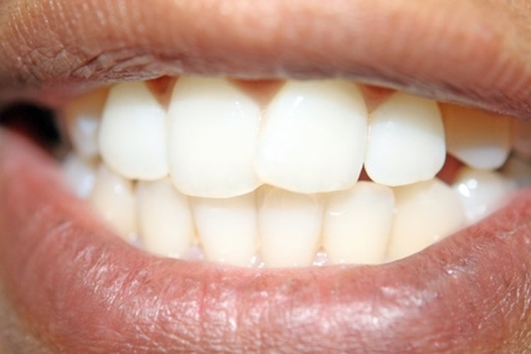 Sólo los profesionales dentales pueden remover el sarro correctamente.