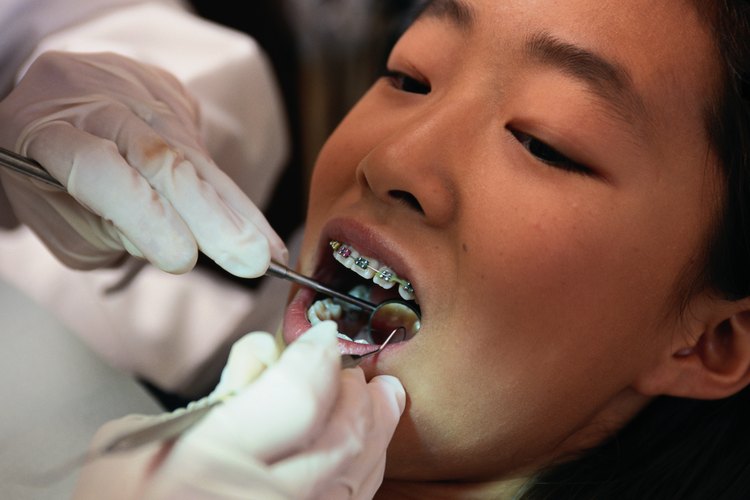 Los frenos de ortodoncia mejoran el aspecto de los dientes y la mordida.