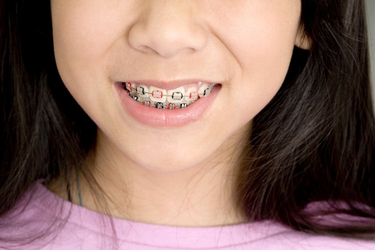 Un ortodoncista puede utilizar los frenos para ayudar a ubicar los dientes más juntos.