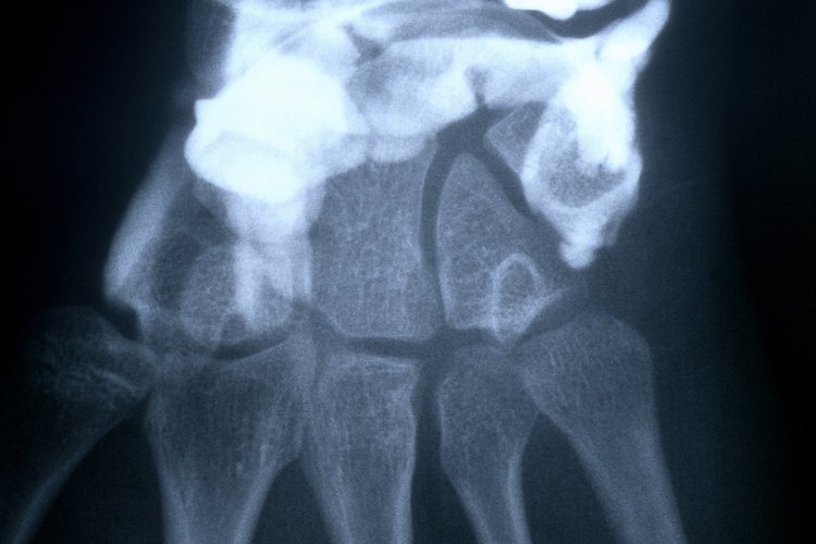 Los bioingenieros diseñan prótesis e implantes médicos más eficaces.