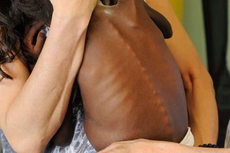 La desnutrición es mortal para los niños.