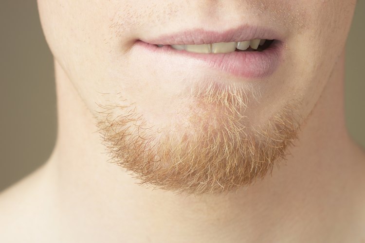El herpes simplex puede causar ampollas en los labios y alrededor de la boca.