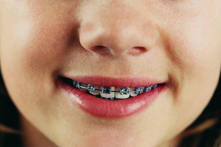 Si el espacio se mantiene después de que los dientes permanentes de tu hijo salen, probablemente no va a desaparecer sin un tratamiento ortodóncico.
