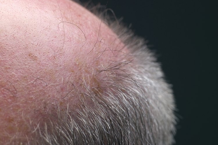 Cómo hacer crecer rápido el pelo en un parche de calvicie en la cabeza.