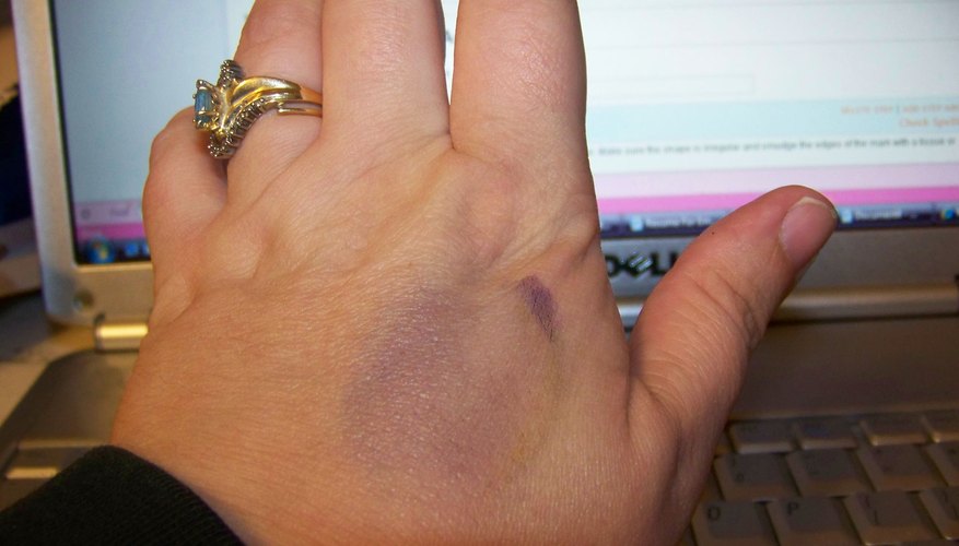 Marker bruise