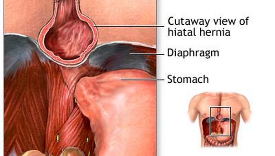 A hiatus hernia occurs when the stomach protrudes its way into the oesophagus