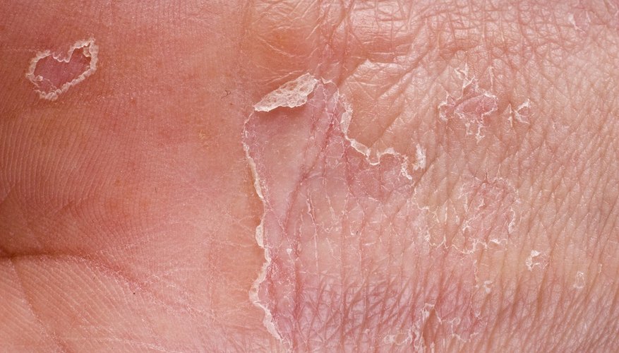 The causes for peeling of skin on your hands can be varried.