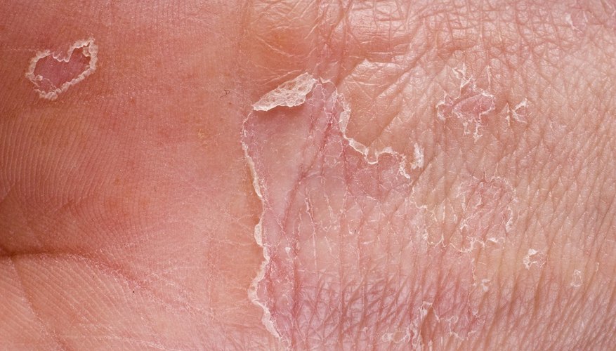 skin-peeling-causes-symptoms-and-how-to-reduce-it