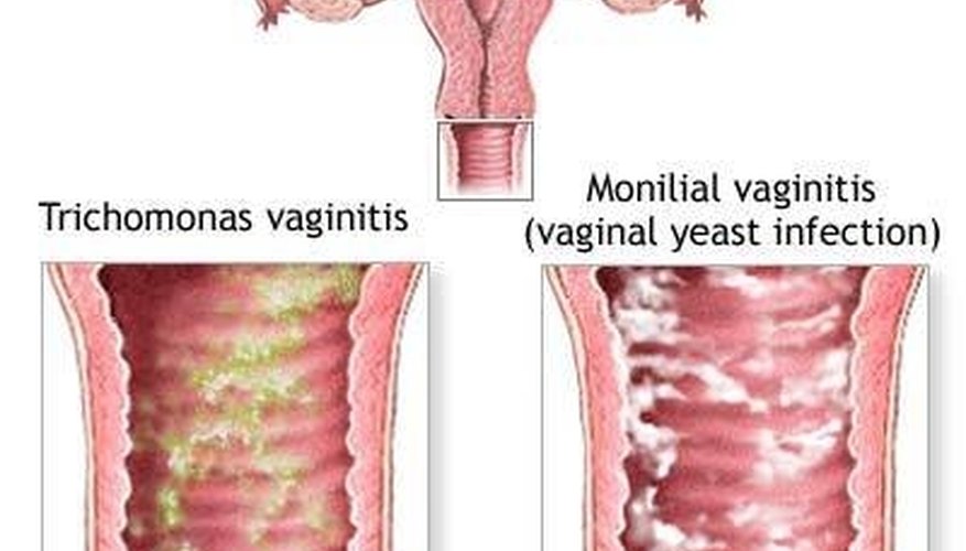 Relief For Vaginal Irritation Itching And Swelling Healthy Living