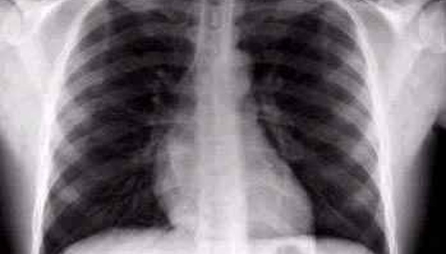 what-does-a-smoker-s-x-ray-look-like-healthy-living