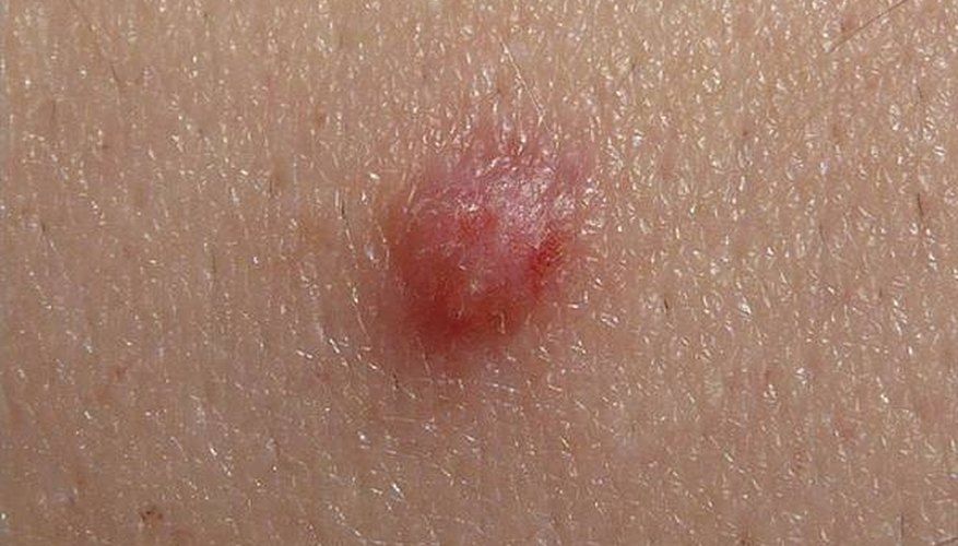 Gammel mand Diplomat tiltrækkende HPV Symptoms on the Skin