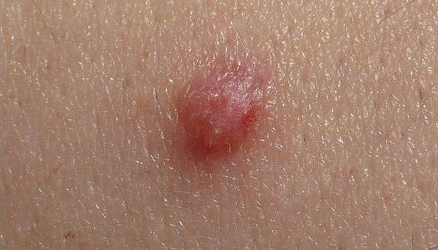 hpv-symptoms-on-the-skin-healthy-living