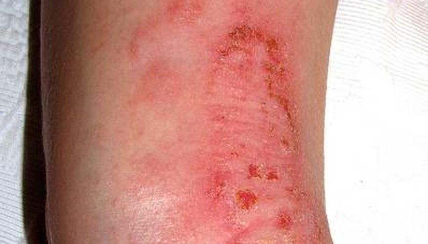 What Foods Can Cause Eczema Healthy Living