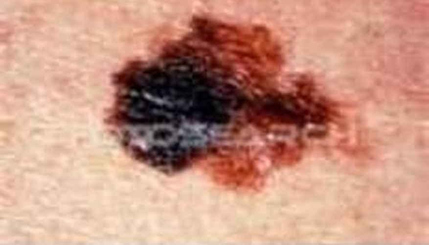 How to tell if moles are skin cancer