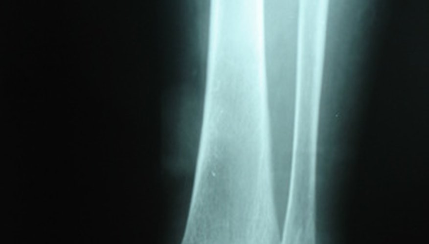 Ankle fractures may require a back slab prior to a full cast.