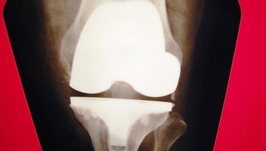 The complex knee joint includes only three bones