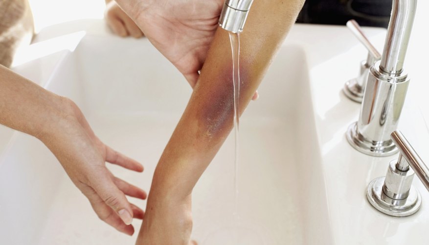 Extreme bruising also includes swelling, especially at the point of impact.