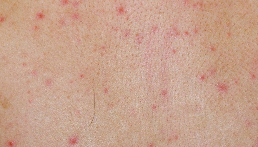 Skin Rashes Caused By Viral Infection Healthy Living