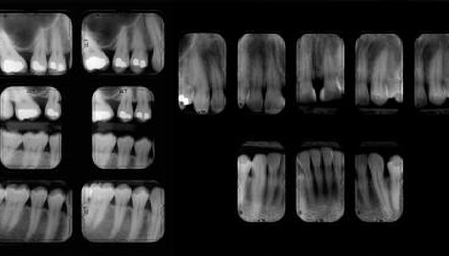 X-rays help illustrate the number of decayed, missing and filled teeth.