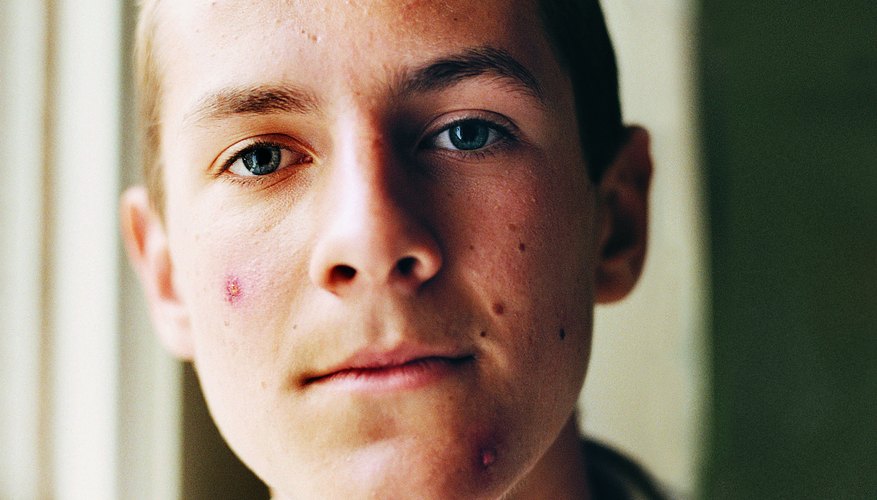 Men can strategically use concealer to cover unsightly blemishes.