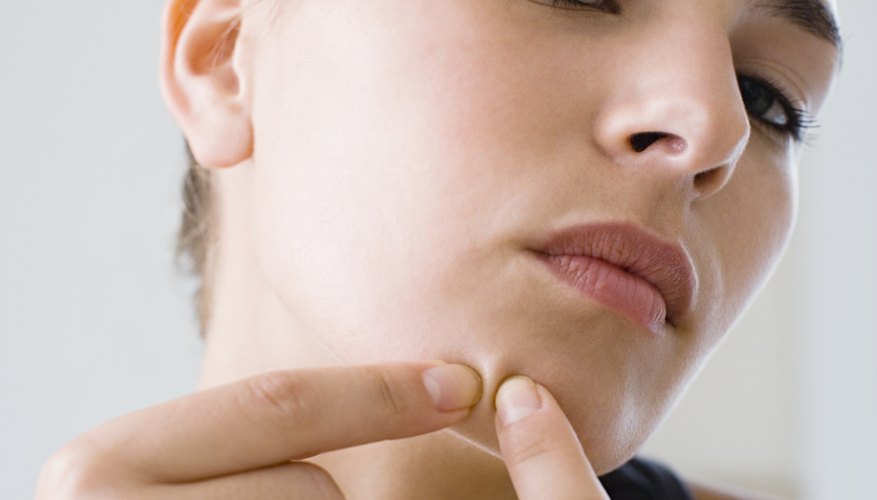 Squeezing blackheads will make the problem worse.