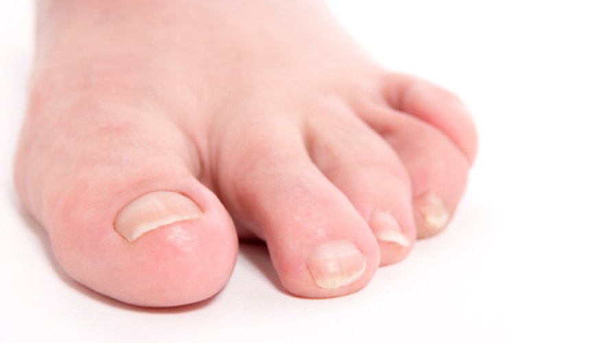 what-do-ridges-in-toenails-mean-healthy-living