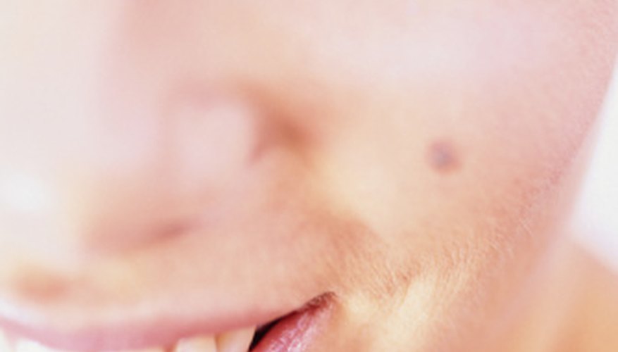 Causes of Moles Bleeding Causes of Moles Bleeding