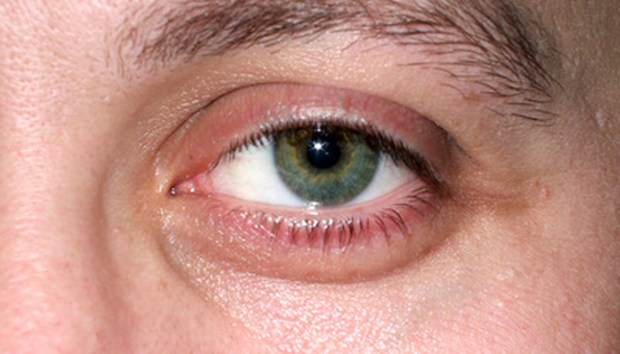 Photo Credit: Eye image by Igor Tsaranenko from <a href='http://www.fotolia.com'>Fotolia.com</a> Strained eye