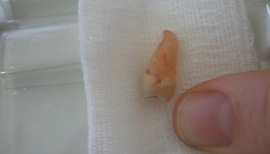 Extracted tooth Extracted tooth