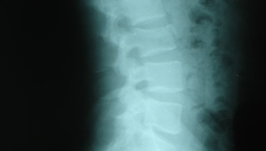 Spine X-Ray Spine X-Ray