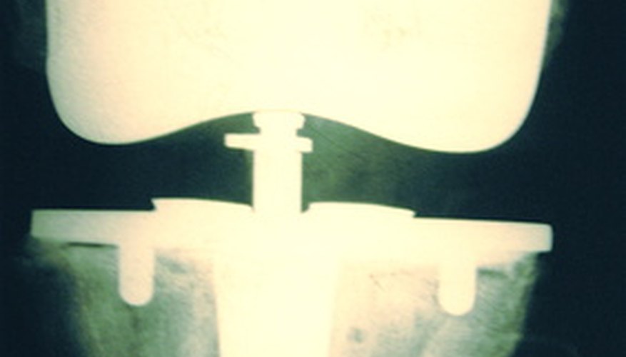 Photo Credit: knee replacement image by JASON WINTER from <a href='http://www.fotolia.com'>Fotolia.com</a>