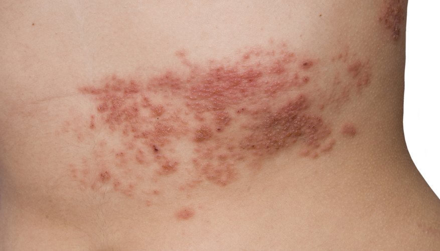 A shingles rash. A shingles rash.