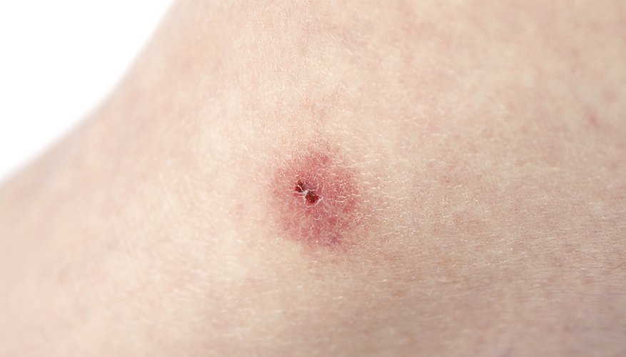 Red, inflamed bug bite. Red, inflamed bug bite.