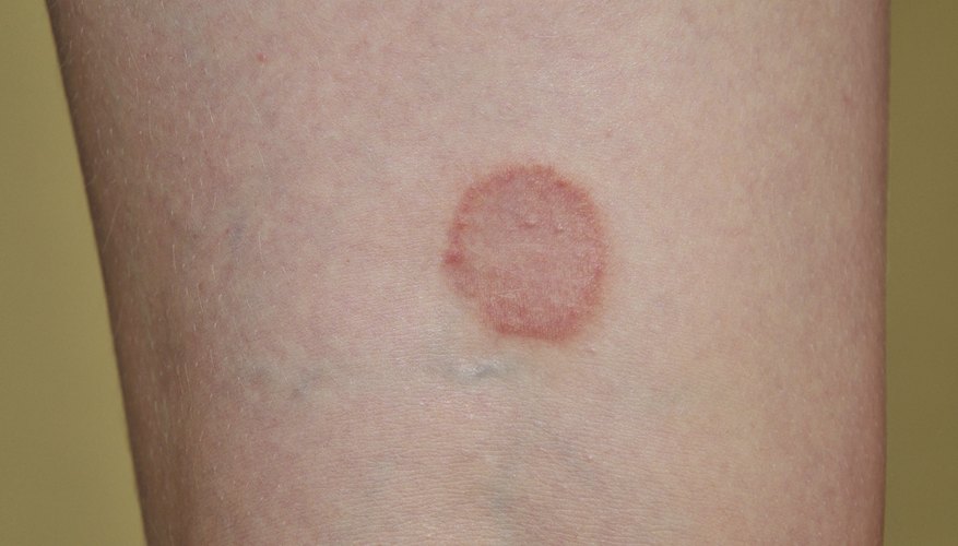 Ringworm rash. Ringworm rash.
