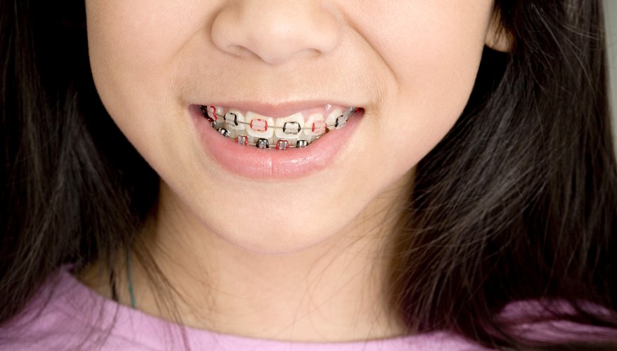 How to Get Free Braces in Los Angeles | Pocket Sense