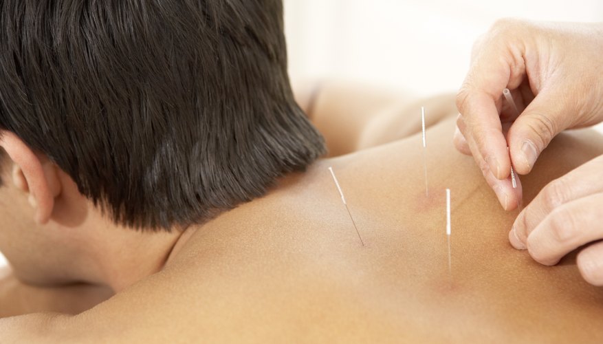 Alternative remedies, such as acupuncture Alternative remedies, such as acupuncture