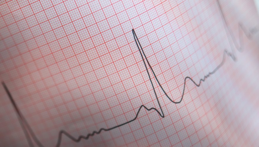 EKG chart EKG chart