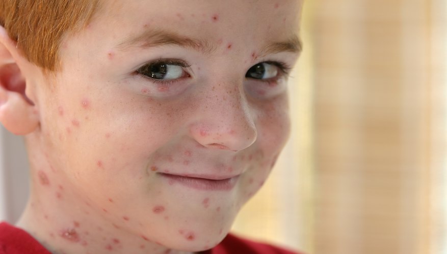 A child with chicken pox. A child with chicken pox.