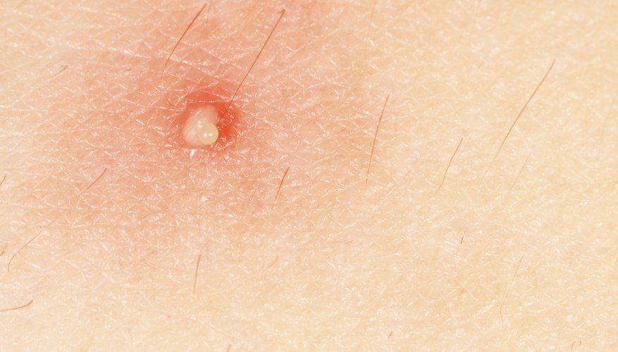 Boil on skin. Boil on skin.