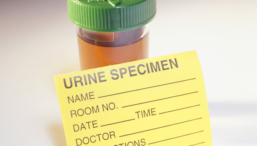 If your blood sugar level rises to a level of 180 or more, your practitioner will find glucose in your urine If your blood sugar level rises to a level of 180 or more, your practitioner will find glucose in your urine