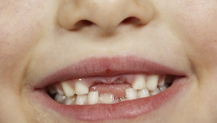 Development Of Space Between Teeth In Children How To Adult