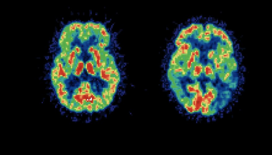 PET brain scan result comparison PET brain scan result comparison