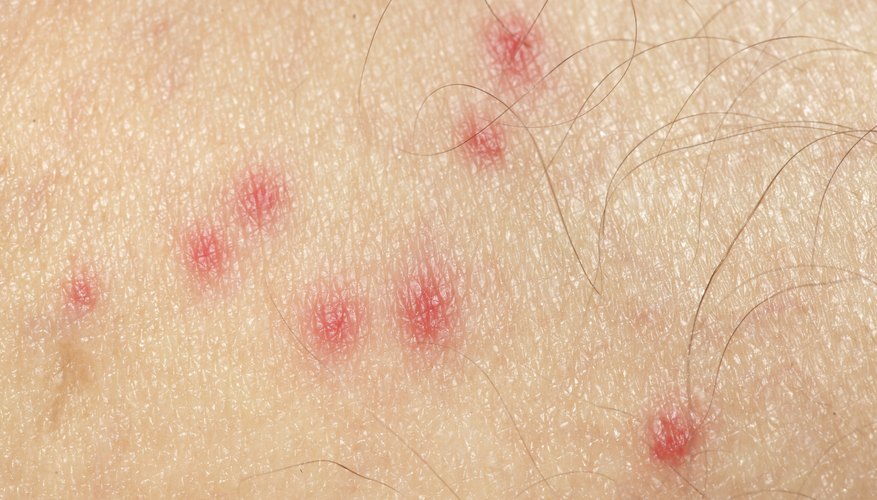 Bug bites on skin. Bug bites on skin.