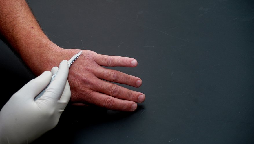 Wart removal from hand. Wart removal from hand.
