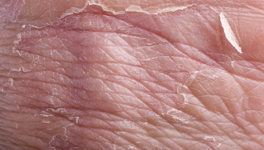 Dermatitis includes skin slaking. Dermatitis includes skin slaking.