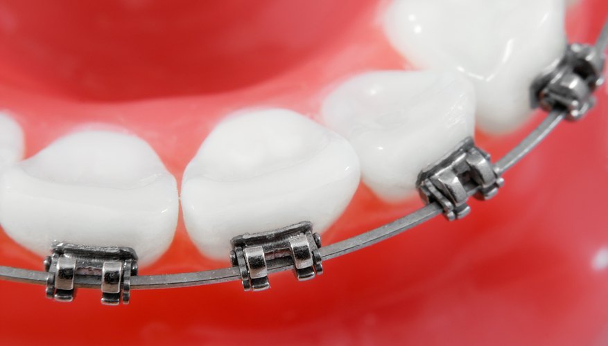 What to Do if Kids Need Braces & You Can't Afford Them | How To Adult