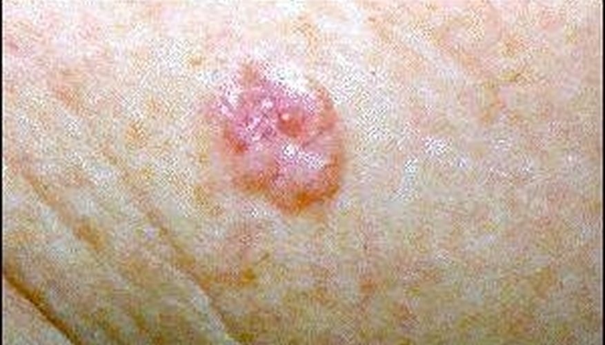 Basal cell Basal cell