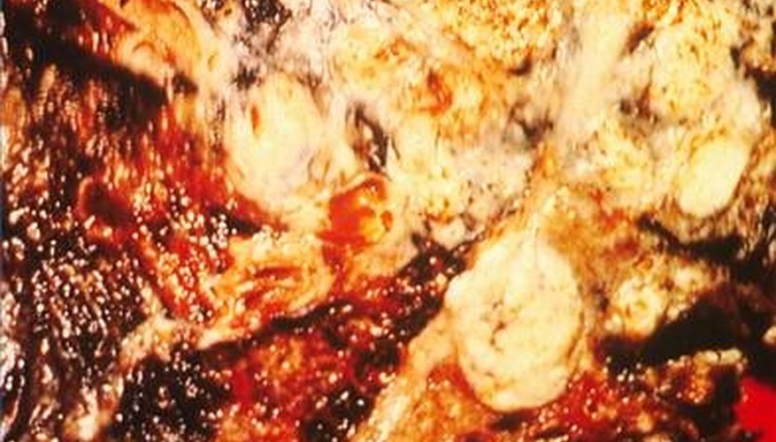 Cross-section of cancerous lung from a smoker (cancer.gov, public domain) Cross-section of cancerous lung from a smoker (cancer.gov, public domain)