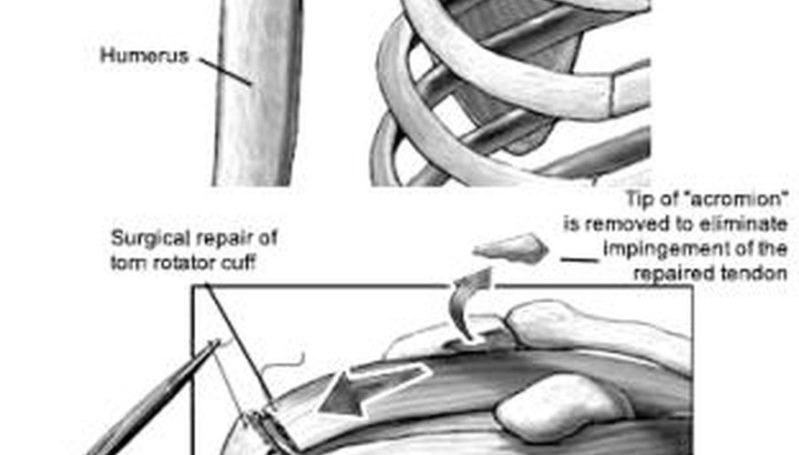 Torn rotator cuff tendon Torn rotator cuff tendon